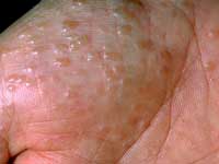 Pictures of Dyshidrotic Eczema