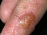 Dyshidrotic Eczema Picture