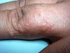 Images of Dyshidrotic eczema