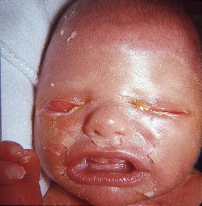 Images of Harlequin Ichthyosis