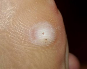 Pictures of Plantar Warts