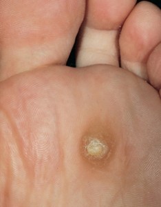 Plantar Warts Picture