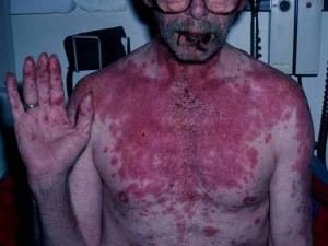 Steven Johnson Syndrome Image