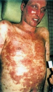 Images of Steven Johnson Syndrome