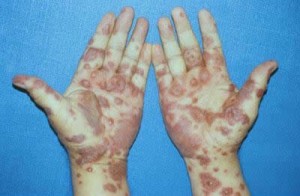 Pictures of Steven Johnson Syndrome