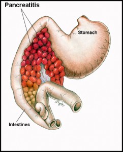 Chronic Pancreatitis Picture 