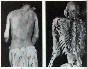 Pictures of Fibrodysplasia Ossificans Progressiva