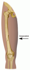 Greenstick Fracture Images