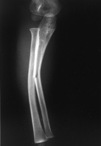 Pictures of Greenstick Fracture