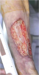 Pyoderma Gangrenosum Images