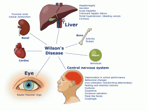 Pictures of Wilson's Disease