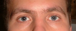 Anisocoria Pictures