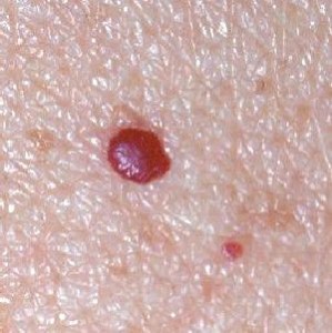 Pictures of Cherry Angioma