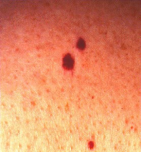 Images of Cherry Angioma