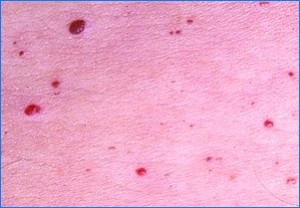 Photos of Cherry Angioma