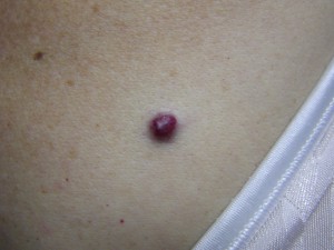 Pictures of Cherry Angioma