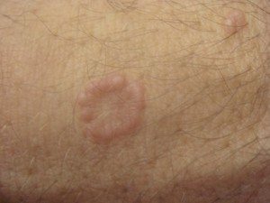 Granuloma Annulare Picture