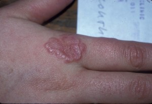 Photos of Granuloma Annulare