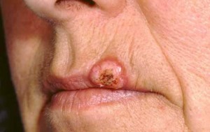 Pictures of Keratoacanthoma