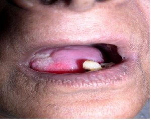 Photos of Leukoplakia