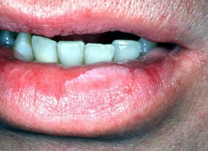 Picture of Leukoplakia