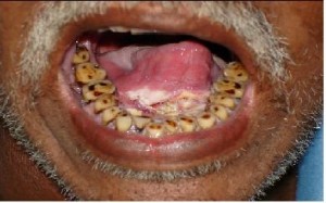 Pictures of Leukoplakia