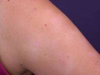 Images of Pityriasis alba