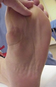 Plantar fibromatosis Images