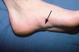 Photos of Plantar fibromatosis