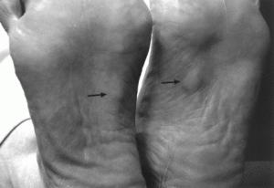 Pictures of Plantar fibromatosis