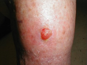 photos of Pyogenic granuloma