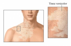 Tinea Versicolor Image