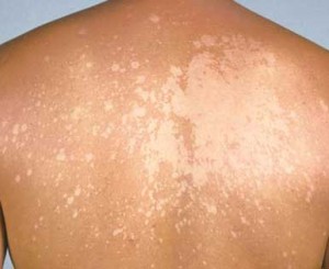 Images of Tinea Versicolor