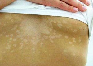 Photos of Tinea Versicolor