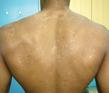 Tinea Versicolor - Pictures, Symptoms, Causes, Prevention 