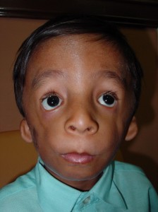 Photos of Treacher Collins Syndrome