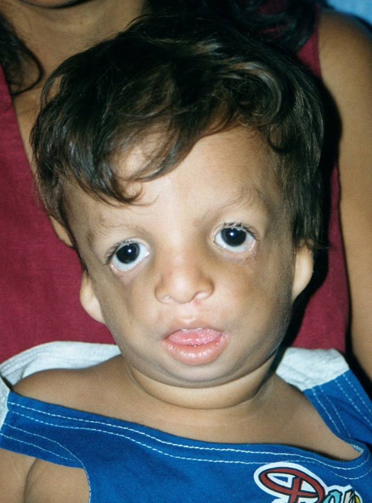 Treacher Collins Syndrome Pictures, Symptoms, Diagnosis, Treatment