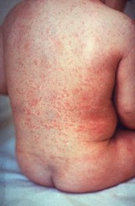 Viral exanthem images