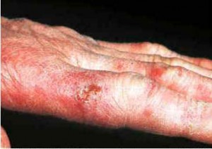 Chilblains Fingers Pictures