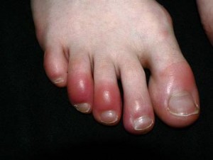 Photos of Chilblains