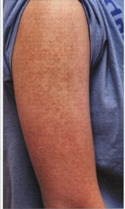 Images of Keratosis Pilaris