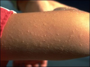 Pictures of Keratosis Pilaris