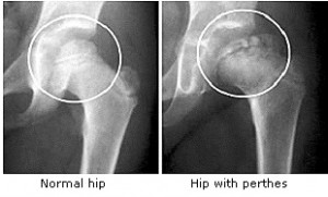 Legg calve perthes disease Pictures