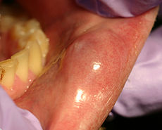 Pictures of Mucocele