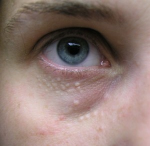 Pictures of Syringoma