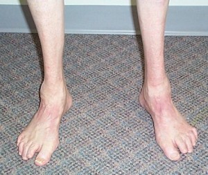 charcot marie tooth disease Photos