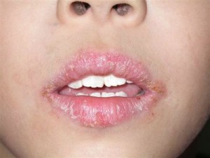 Angular cheilitis Photos