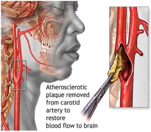 Carotid Endarterectomy Images