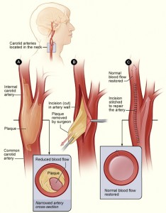 Carotid Endarterectomy Photos