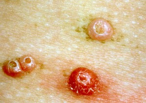 Image of Molluscum Contagiosum